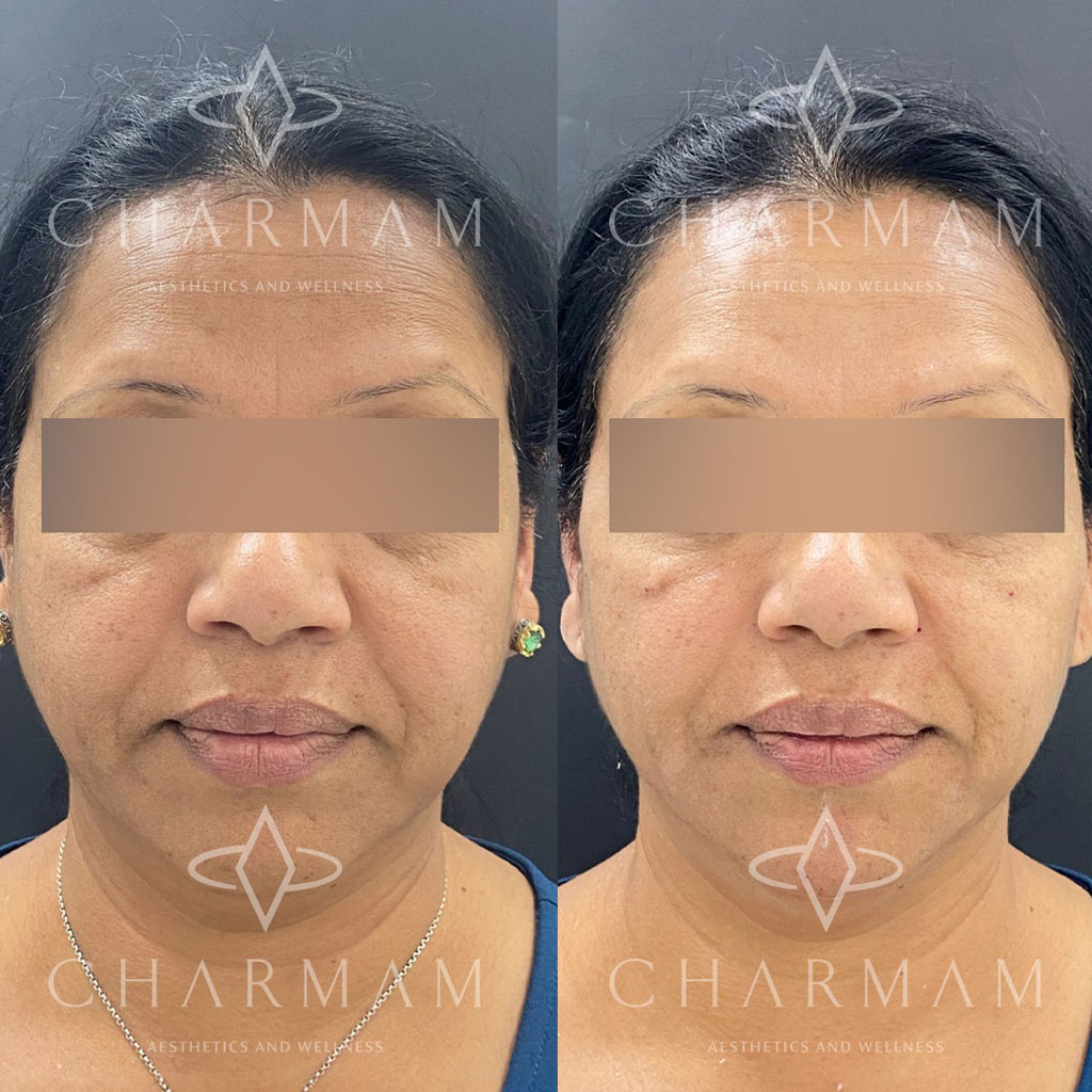 Charmam Glutathione IV Program