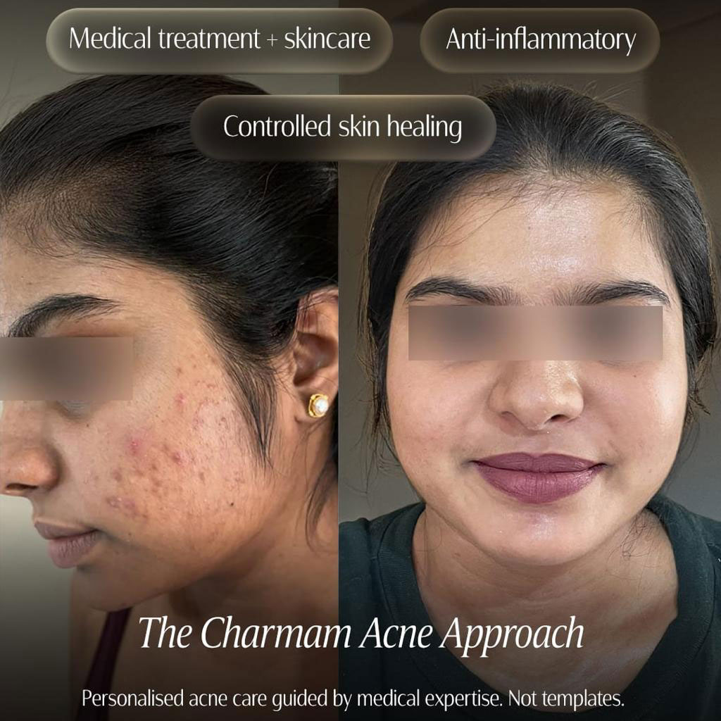 Acne & Pigmentation Protocol 