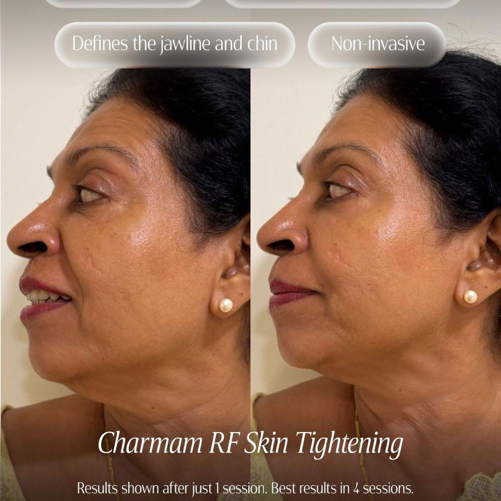Charmam RF Skin Tightening
