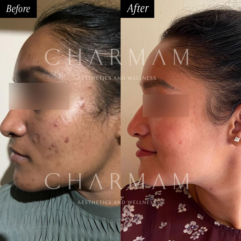 Acne & Pigmentation Protocol 