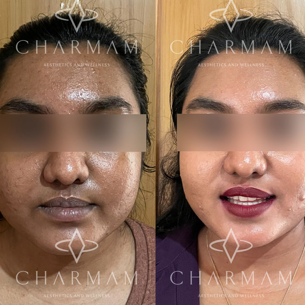 Acne & Pigmentation Protocol 