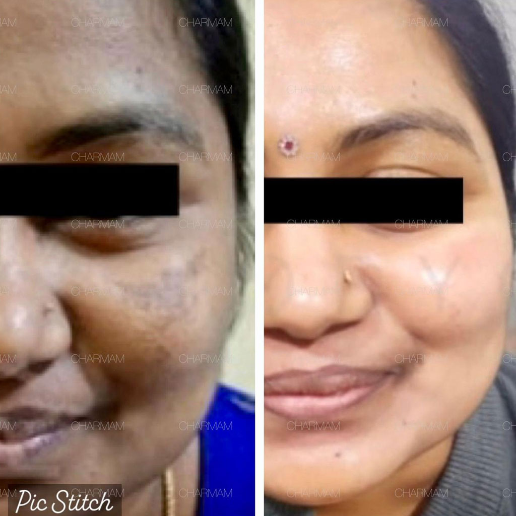 Pigmentation Before After